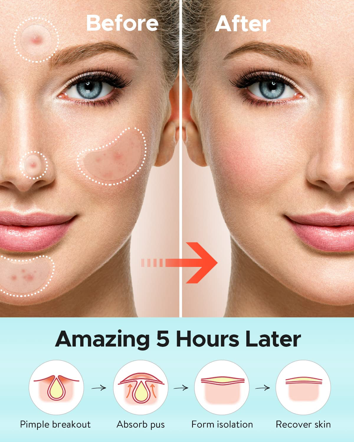 Acne Patches Large, Hydrocolloid Pimple Patches for Large Breakouts, Zit and Blemish, Large Acne Patches for Face, Chin, Back and Body with Tea Tree Oil